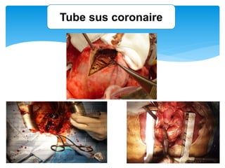 Tube sus coronaire
 