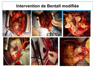 Intervention de Bentall modifiée
 