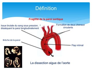 Définition
Fragilité de la paroi aortique
Brèche de la paroi
Issue brutale du sang sous pression,
disséquant la paroi longitudinalement
Formation de deux chenaux
circulants
Flap intimal
La dissection aigue de l’aorte
 