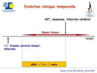 temps
Signes locaux
AIT, amaurose, infarctus cérébral
+/- trauma cervical mineur,
infection
délai < 1 h – 1 mois
Biousse, Stroke 1995; Beletsky, Stroke 2003
Evolution clinique temporelle
 