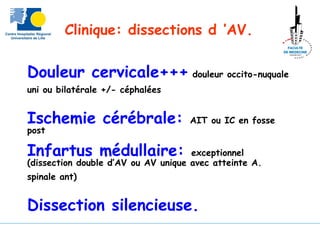 Douleur cervicale+++ douleur occito-nuquale
uni ou bilatérale +/- céphalées
Ischemie cérébrale: AIT ou IC en fosse
post
Infartus médullaire: exceptionnel
(dissection double d’AV ou AV unique avec atteinte A.
spinale ant)
Dissection silencieuse.
Clinique: dissections d ’AV.
 