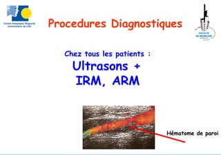 Chez tous les patients :
Ultrasons +
IRM, ARM
Procedures Diagnostiques
Hématome de paroi
 