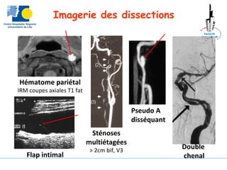 Imagerie des dissections
Flap intimal
Double
chenal
Hématome pariétal
IRM coupes axiales T1 fat
Pseudo A
disséquant
Sténoses
multiétagées
> 2cm bif, V3
 