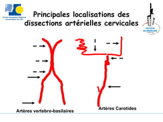 Principales localisations des
dissections artérielles cervicales
Artères vertebro-basilaires
Artères Carotides
 