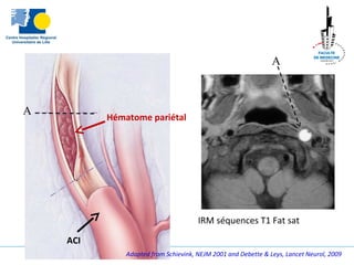 A
A
Hématome pariétal
IRM séquences T1 Fat sat
ACI
Adapted from Schievink, NEJM 2001 and Debette & Leys, Lancet Neurol, 2009
 
