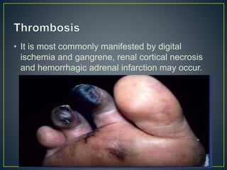 • It is most commonly manifested by digital
ischemia and gangrene, renal cortical necrosis
and hemorrhagic adrenal infarction may occur.
 