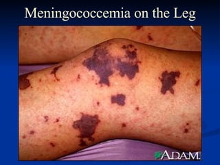 Meningococcemia on the Leg 