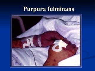Purpura fulminans 