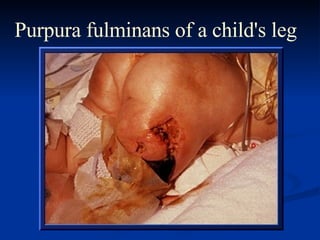 Purpura fulminans of a child's leg 