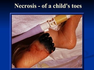 Necrosis - of a child's toes 