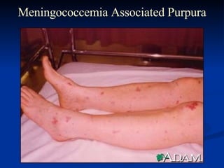 Meningococcemia Associated Purpura 