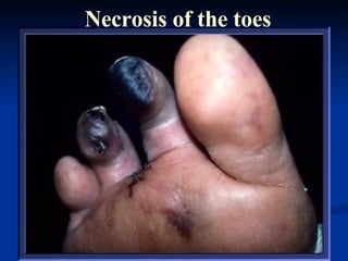 Necrosis of the toes 