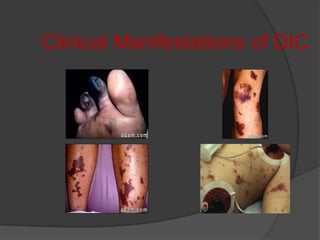 Clinical  Manifestations of DICIschemic Findingsare earliest!Bleeding is the most obvious clinical finding