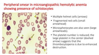 Peripheral smear in microangiopathic hemolytic anemia
showing presence of schistocytes
• Multiple helmet cells (arrows)
• Fragmented red cells (small
arrowhead)
• Microspherocytes are also seen (large
arrowheads).
• The platelet number is reduced; the
large platelet in the center (dashed
arrow) suggests that the
thrombocytopenia is due to enhanced
destruction.
 