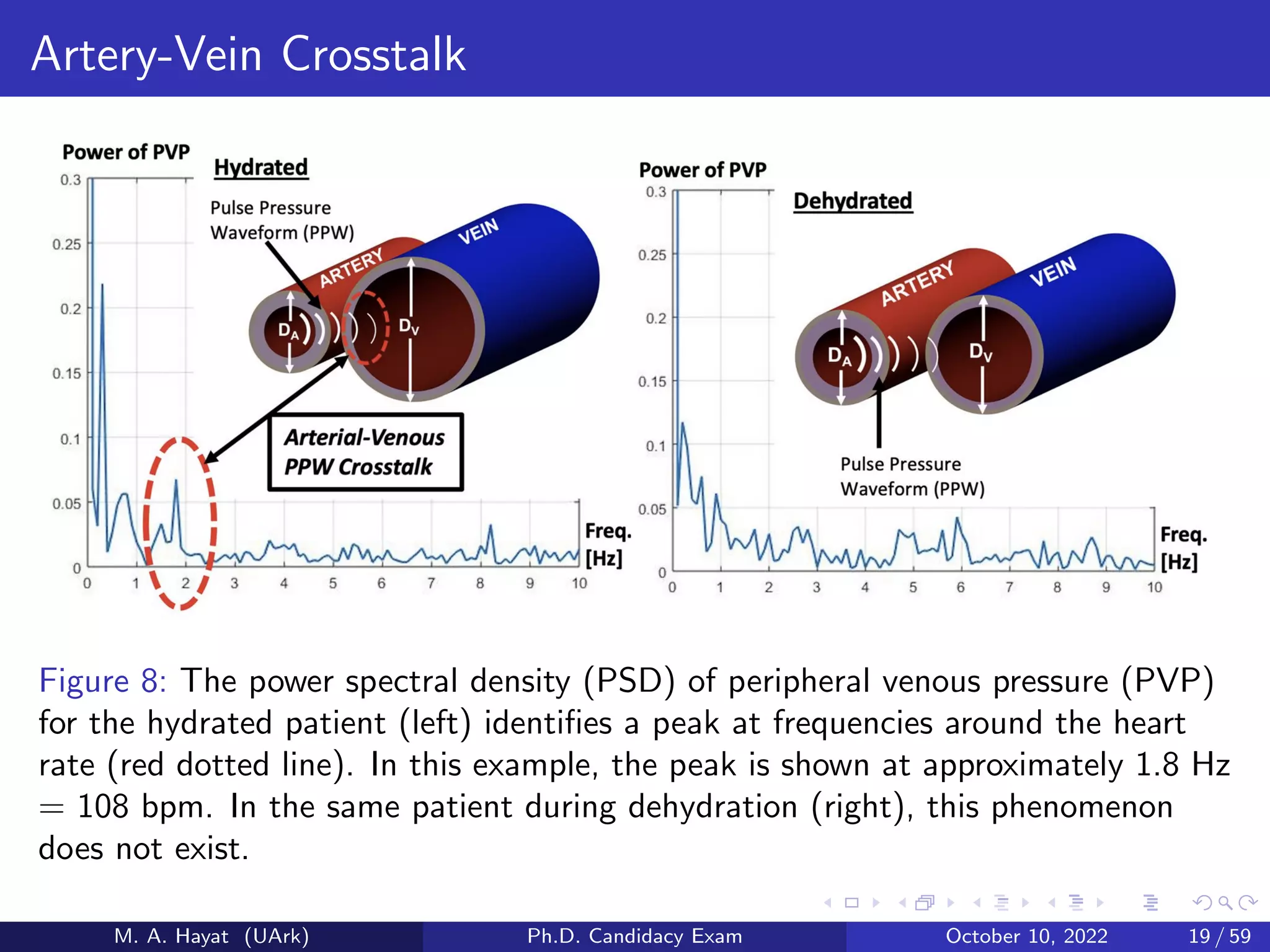 Artery-Vein Crosstalk
Figure 8: The power spectral density (PSD) of peripheral venous pressure (PVP)
for the hydrated patient (left) identifies a peak at frequencies around the heart
rate (red dotted line). In this example, the peak is shown at approximately 1.8 Hz
= 108 bpm. In the same patient during dehydration (right), this phenomenon
does not exist.
M. A. Hayat (UArk) Ph.D. Candidacy Exam October 10, 2022 19 / 59
 