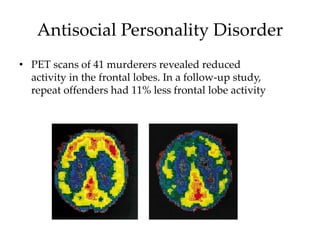 Antisocial Personality Disorder
• PET scans of 41 murderers revealed reduced
activity in the frontal lobes. In a follow-up study,
repeat offenders had 11% less frontal lobe activity
 