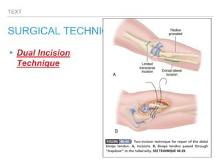 TEXT
SURGICAL TECHNIQUES
▸Dual Incision
Technique
 