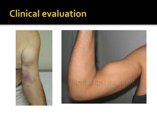 Distal biceps tendon rupture - by Hussain Algawahmed | PPTX