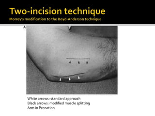 Distal biceps tendon rupture - by Hussain Algawahmed | PPTX