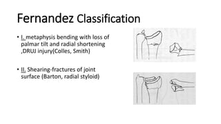 Fernandez Classification
• I. metaphysis bending with loss of
palmar tilt and radial shortening
,DRUJ injury(Colles, Smith)
• II. Shearing-fractures of joint
surface (Barton, radial styloid)
 