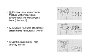 • III. Compression-intraarticular
fracture with impaction of
subchondral and metaphyseal
bone (die-punch)
• IV. Avulsion-fractures of ligament
attachments (ulna, radial styloid)
• V. Combined/complex - high
velocity injuries
 