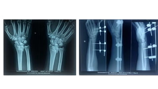 DISTAL END OF RADIUS FRACTURE AND DISLOCATION MANAGEMENT.pptx