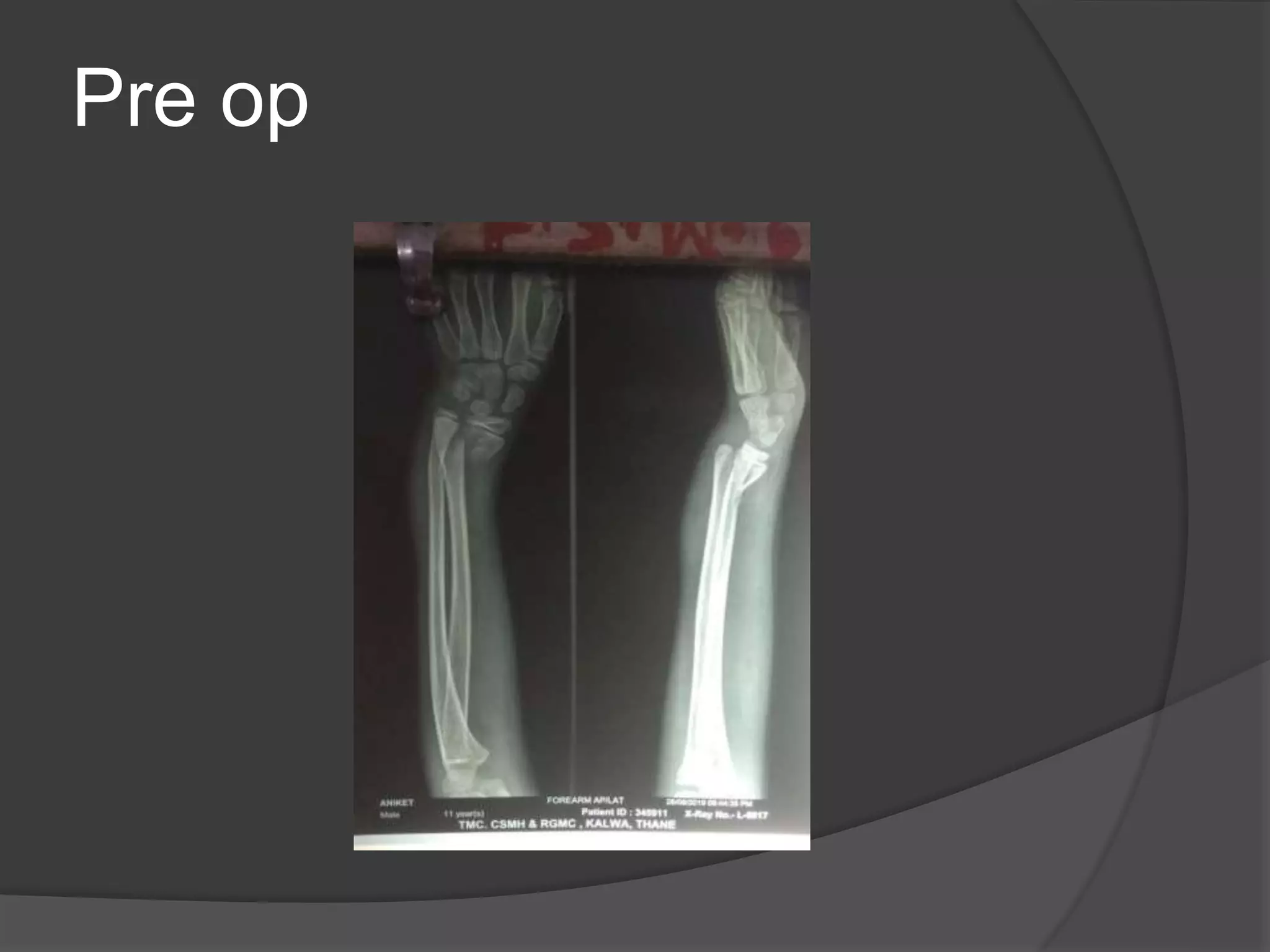 Distal end radius fractures management | PPT