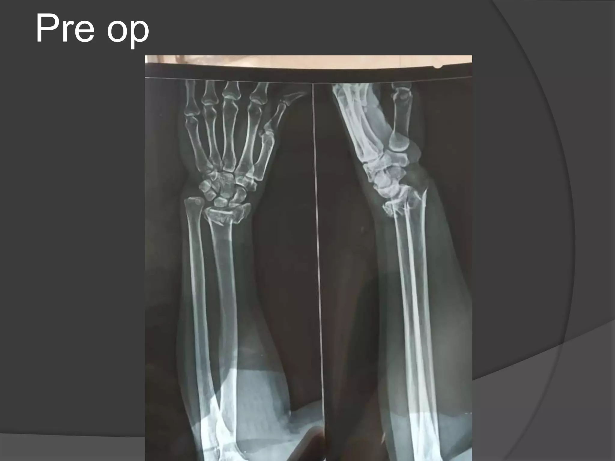 Distal end radius fractures management | PPT