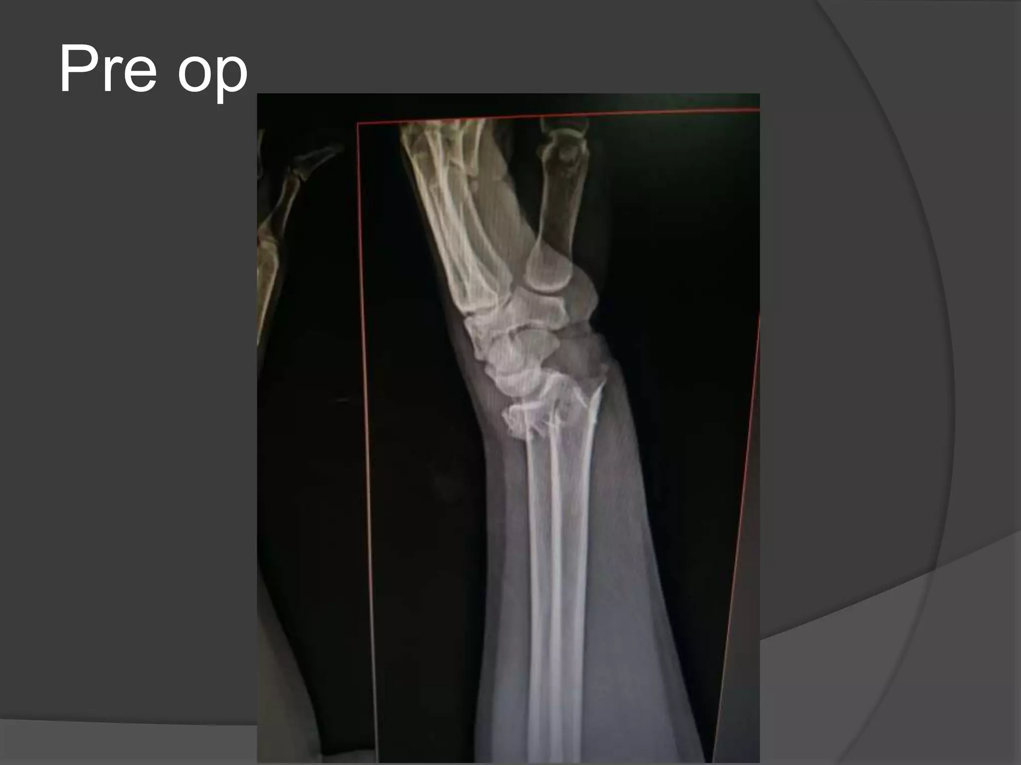 Distal end radius fractures management | PPT