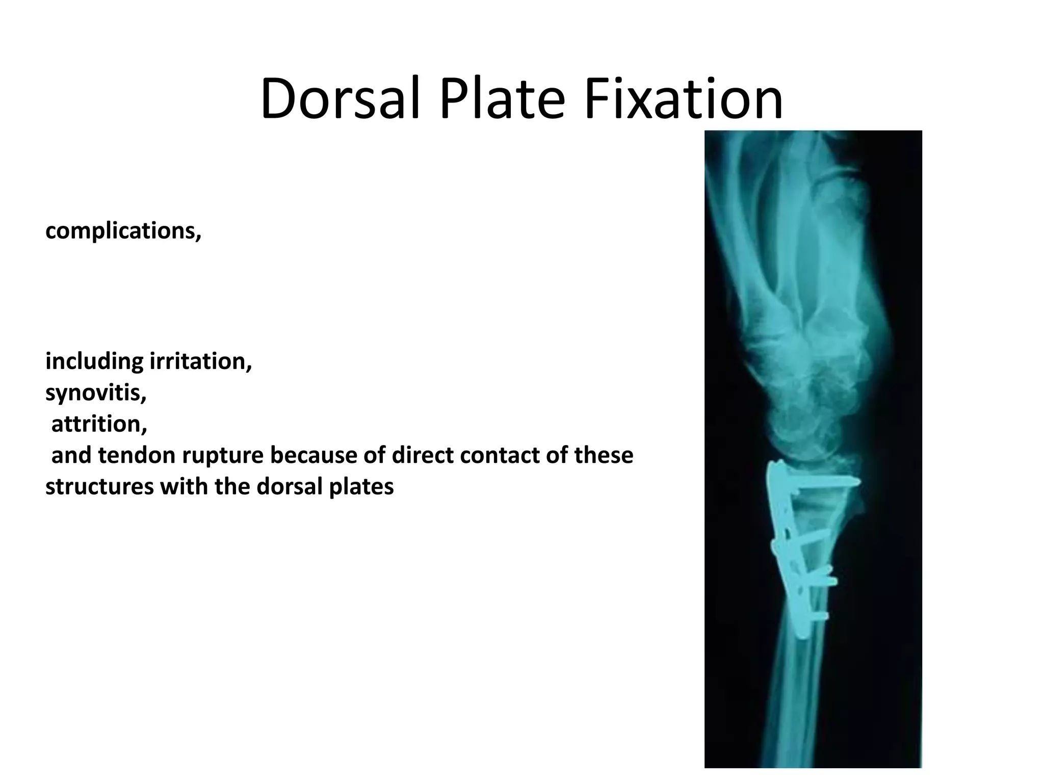 Dorsal Plate Fixation
including irritation,
synovitis,
attrition,
and tendon rupture because of direct contact of these
structures with the dorsal plates
complications,
 