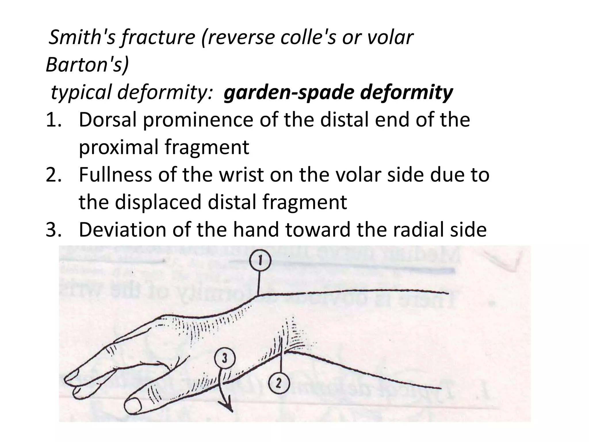 Smith's fracture (reverse colle's or volar
Barton's)
typical deformity: garden-spade deformity
1. Dorsal prominence of the distal end of the
proximal fragment
2. Fullness of the wrist on the volar side due to
the displaced distal fragment
3. Deviation of the hand toward the radial side
 