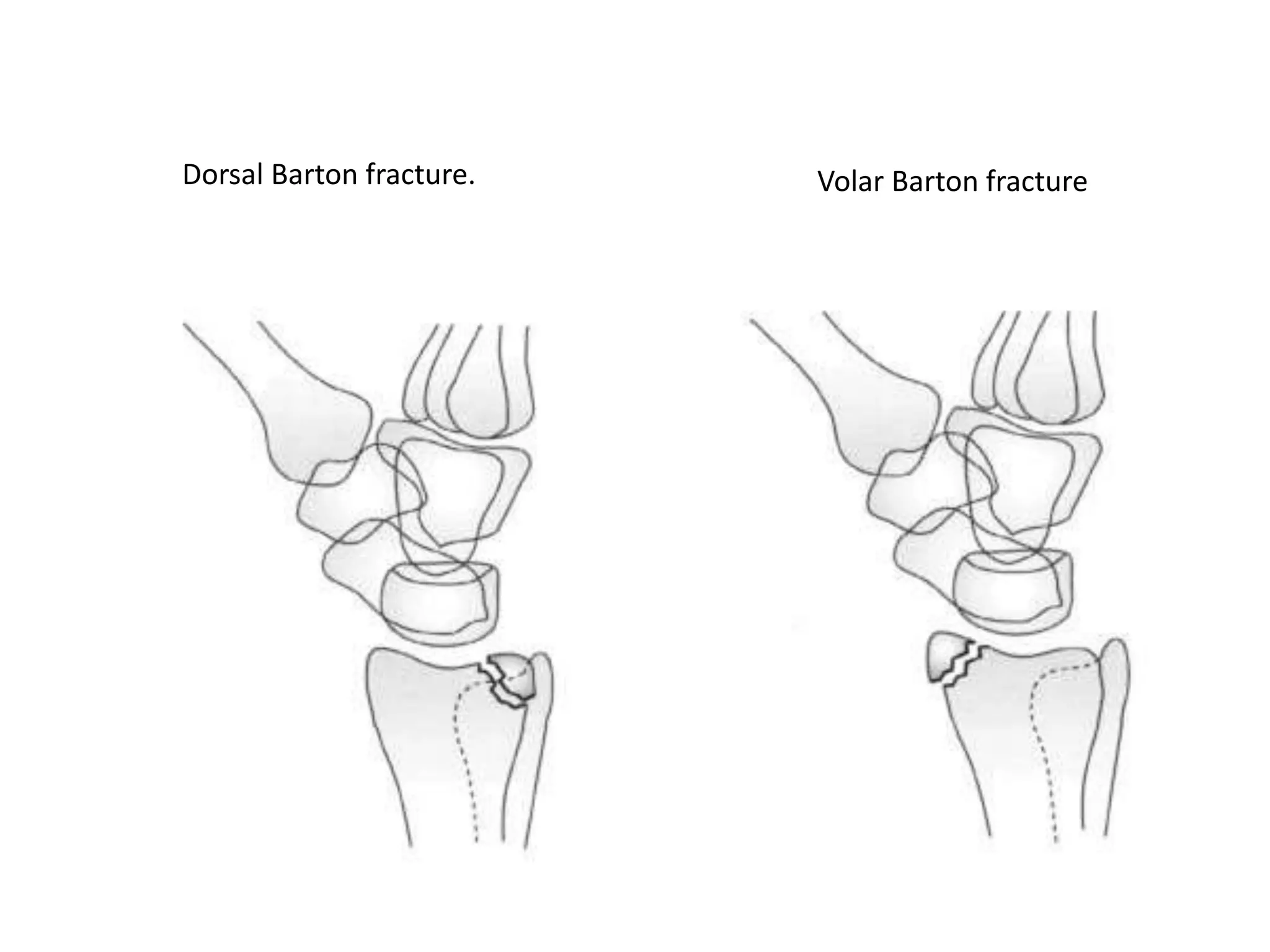Dorsal Barton fracture. Volar Barton fracture
 