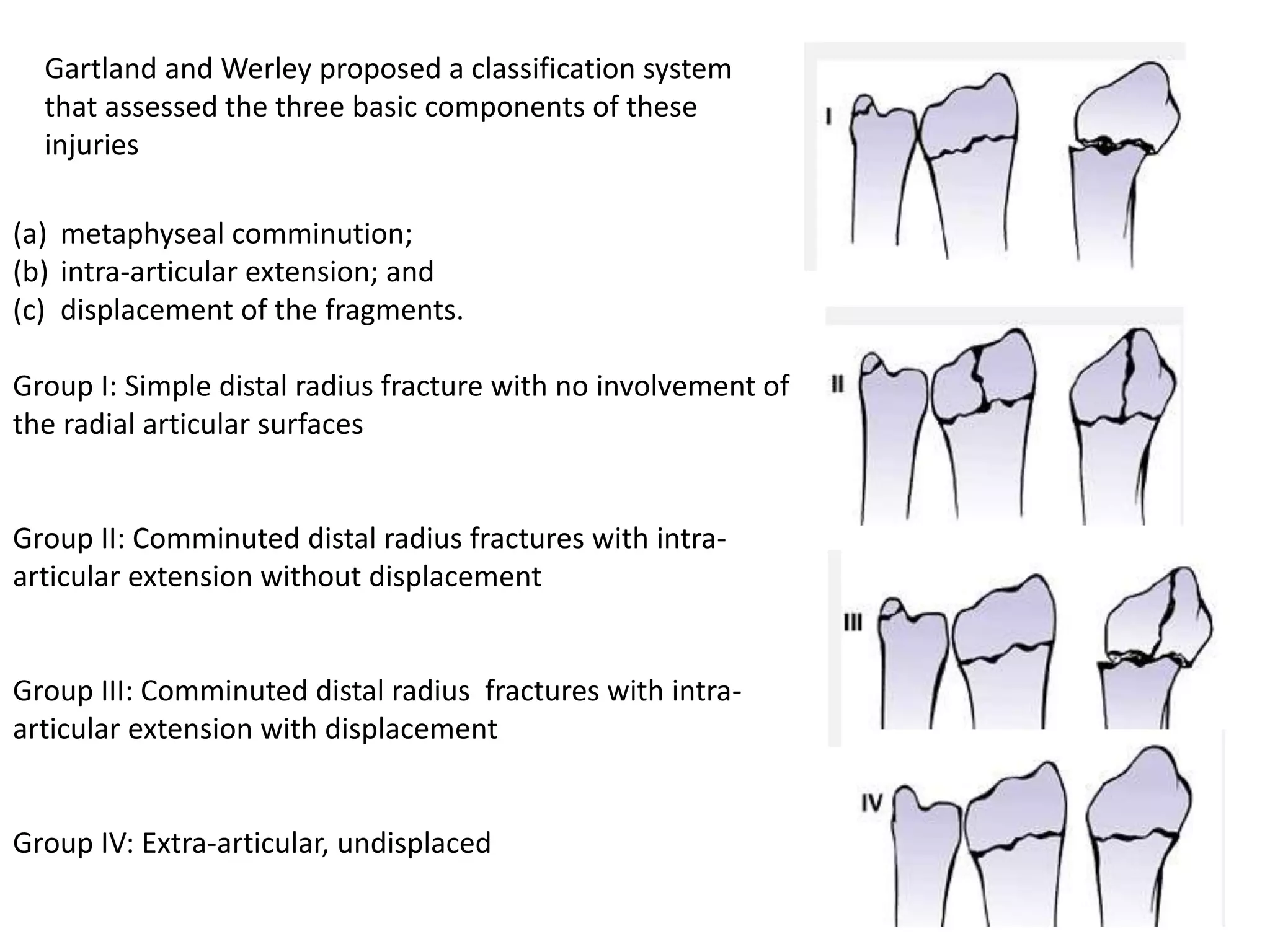 (a) metaphyseal comminution;
(b) intra-articular extension; and
(c) displacement of the fragments.
Group I: Simple distal radius fracture with no involvement of
the radial articular surfaces
Group II: Comminuted distal radius fractures with intra-
articular extension without displacement
Group III: Comminuted distal radius fractures with intra-
articular extension with displacement
Group IV: Extra-articular, undisplaced
Gartland and Werley proposed a classification system
that assessed the three basic components of these
injuries
 