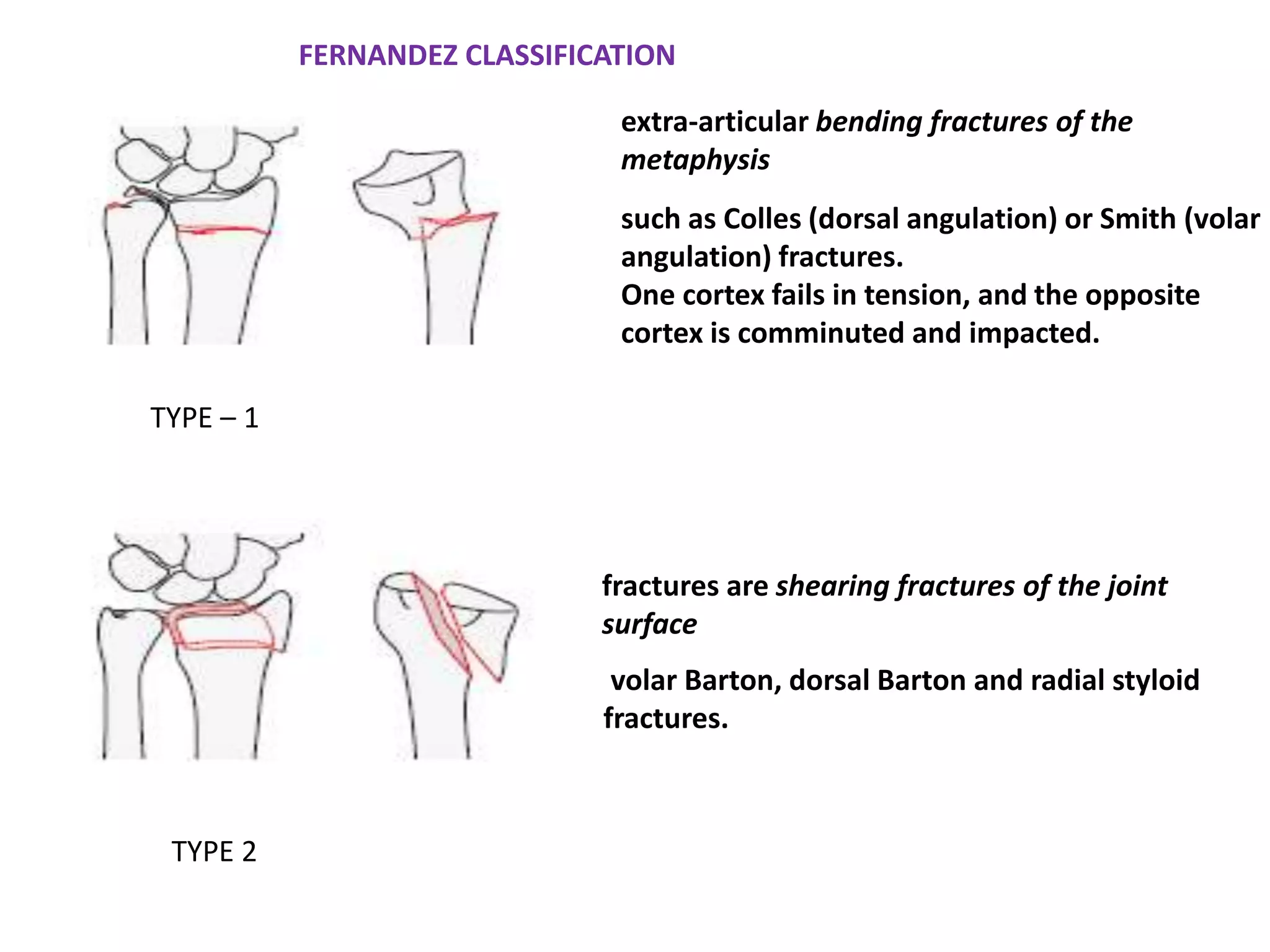such as Colles (dorsal angulation) or Smith (volar
angulation) fractures.
One cortex fails in tension, and the opposite
cortex is comminuted and impacted.
volar Barton, dorsal Barton and radial styloid
fractures.
extra-articular bending fractures of the
metaphysis
fractures are shearing fractures of the joint
surface
FERNANDEZ CLASSIFICATION
TYPE – 1
TYPE 2
 