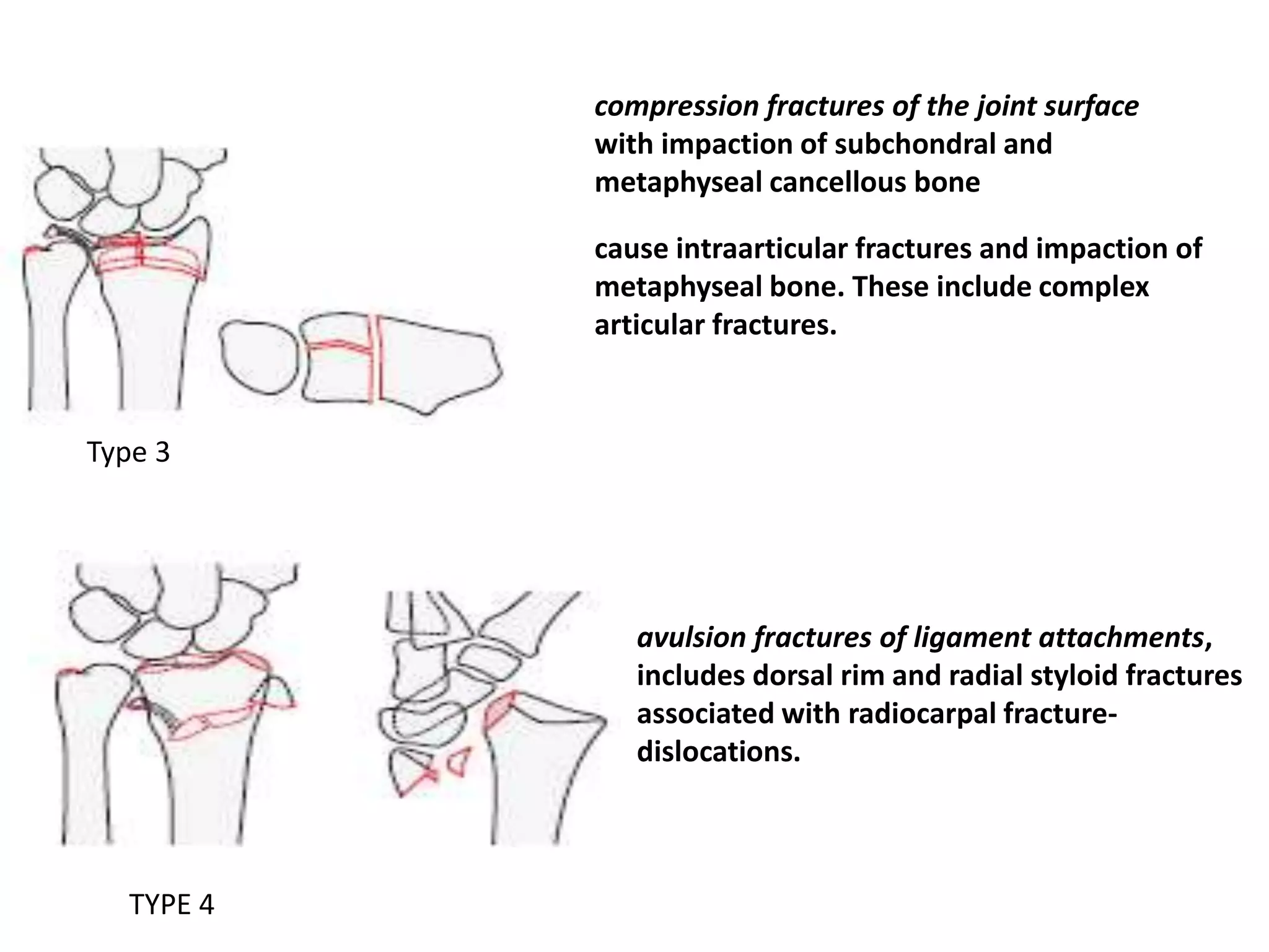 Type 3
cause intraarticular fractures and impaction of
metaphyseal bone. These include complex
articular fractures.
compression fractures of the joint surface
with impaction of subchondral and
metaphyseal cancellous bone
avulsion fractures of ligament attachments,
includes dorsal rim and radial styloid fractures
associated with radiocarpal fracture-
dislocations.
TYPE 4
 