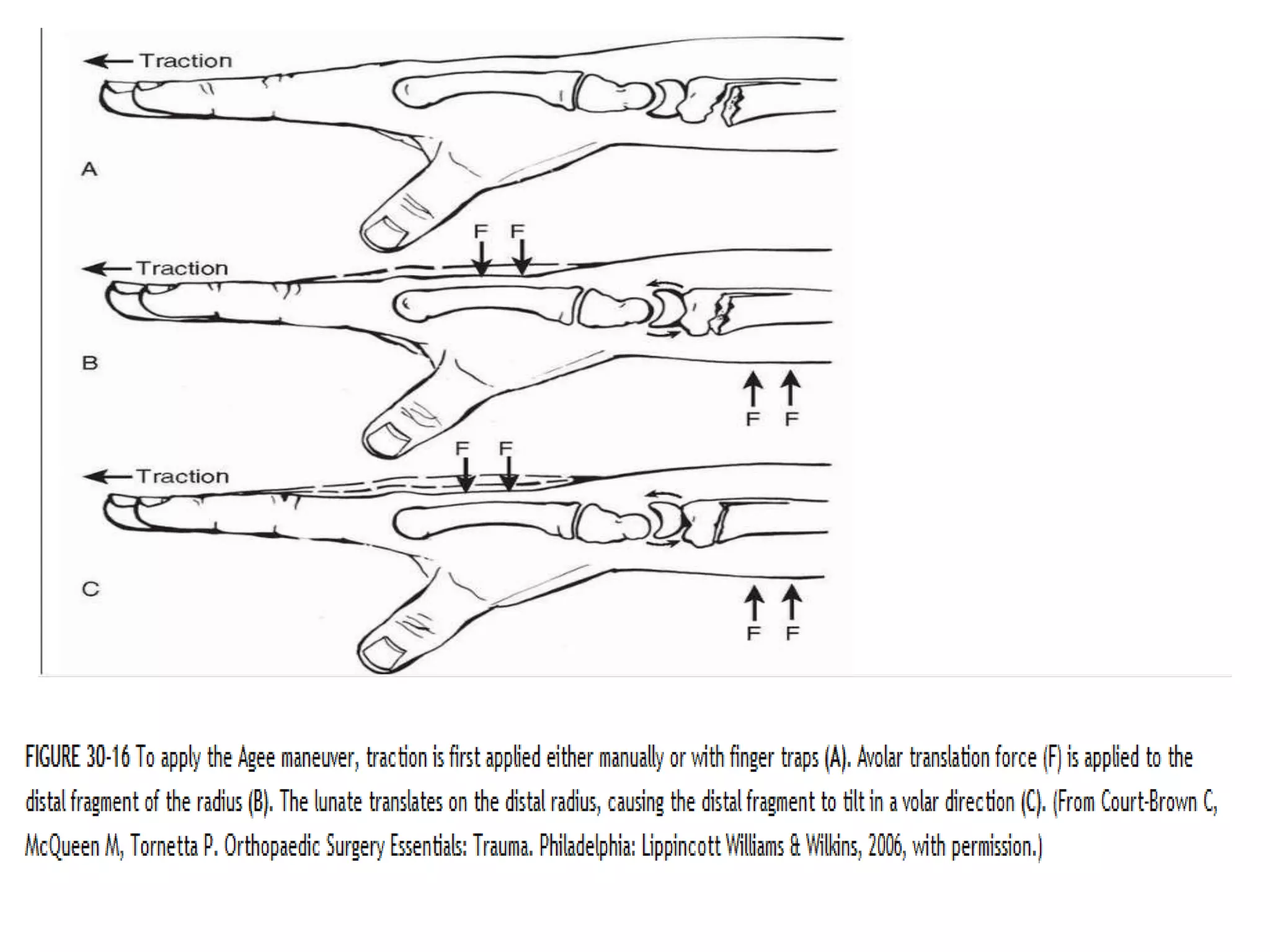 A careful examination of the patient is performed with particular attention to (1) skin
quality and integrity, (2) median and ulnar nerve function as measured by 2-point
discrimination, and (3) continuity of the extrinsic digital flexor and extensor tendons, most
importantly those to the thumb.
 