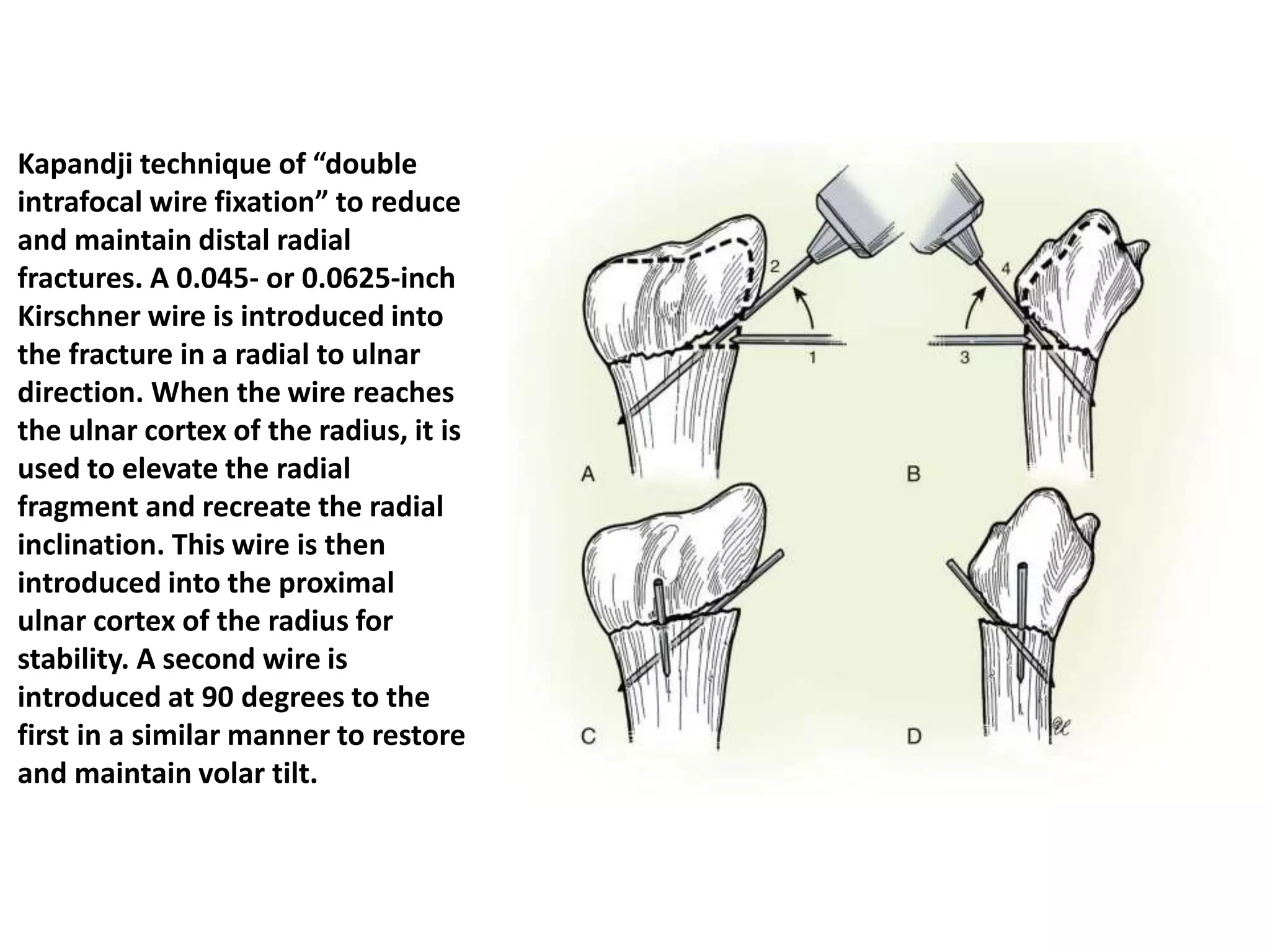 Kapandji technique of “double
intrafocal wire fixation” to reduce
and maintain distal radial
fractures. A 0.045- or 0.0625-inch
Kirschner wire is introduced into
the fracture in a radial to ulnar
direction. When the wire reaches
the ulnar cortex of the radius, it is
used to elevate the radial
fragment and recreate the radial
inclination. This wire is then
introduced into the proximal
ulnar cortex of the radius for
stability. A second wire is
introduced at 90 degrees to the
first in a similar manner to restore
and maintain volar tilt.
 