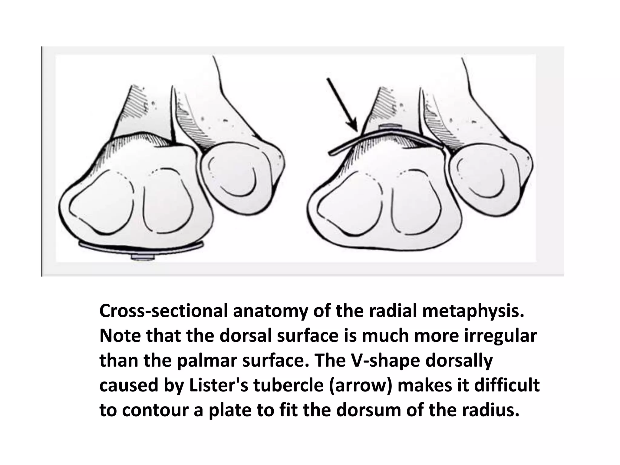 Cross-sectional anatomy of the radial metaphysis.
Note that the dorsal surface is much more irregular
than the palmar surface. The V-shape dorsally
caused by Lister's tubercle (arrow) makes it difficult
to contour a plate to fit the dorsum of the radius.
 