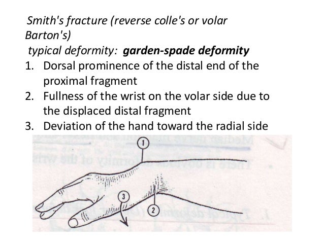 Distal End Radius Fracture