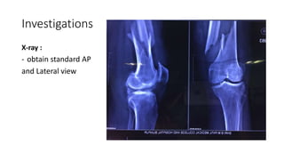 Investigations
X-ray :
- obtain standard AP
and Lateral view
 