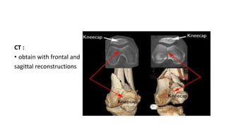 CT :
• obtain with frontal and
sagittal reconstructions
 