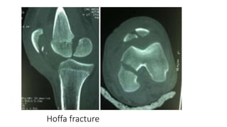Hoffa fracture
 