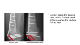 • In many cases, the devices
used to fix a fracture break
or loosen when the fracture
fails to heal.
 