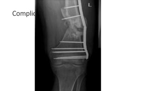 Complications ( cont .. )
 