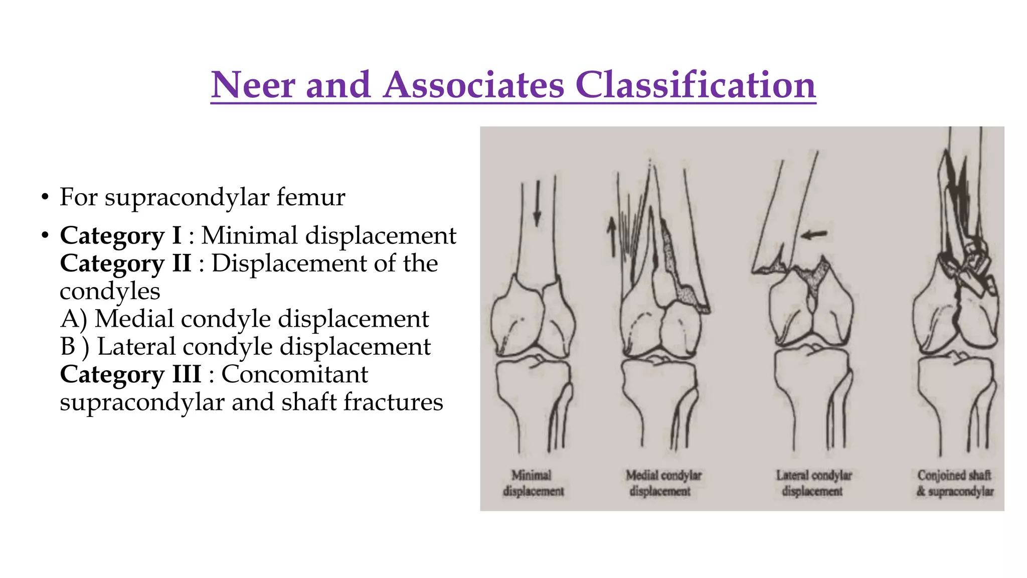 Nehr Classification Distal femur fractures dr.shubham.pptx