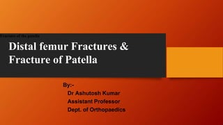 Fracture of the patella
Distal femur Fractures &
Fracture of Patella
By:-
Dr Ashutosh Kumar
Assistant Professor
Dept. of Orthopaedics
 