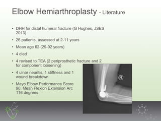 Tfdh Distal Humeral Fractures – How to Fix Them, with Correlation with ...