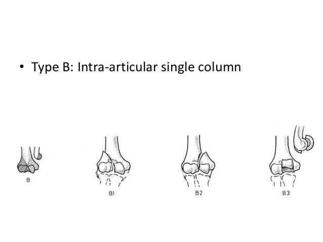 Distal humerus fractures