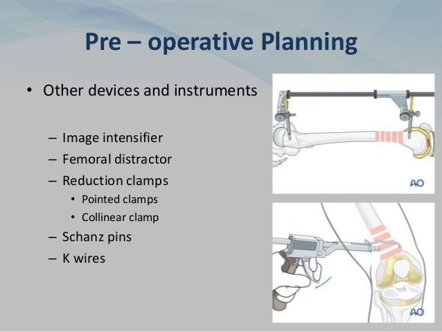 Pre – operative Planning
• Other devices and instruments
– Image intensifier
– Femoral distractor
– Reduction clamps
• Pointed clamps
• Collinear clamp
– Schanz pins
– K wires
 