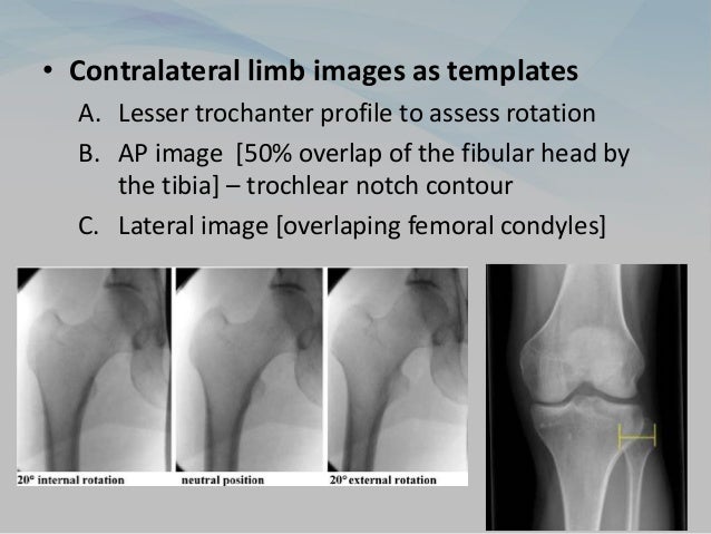 • Contralateral limb images as templates
A. Lesser trochanter profile to assess rotation
B. AP image [50% overlap of the fibular head by
the tibia] – trochlear notch contour
C. Lateral image [overlaping femoral condyles]
 